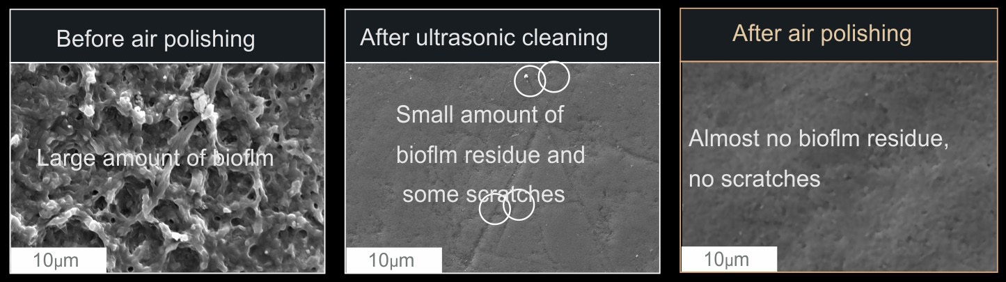 Ef ective protection of tooth suuace The hardness of the air-polishing powder is much Iower than that of the enamel. Therefore, our teeth can be protected better during cleaning, avoiding the tooth surace damage caused by excessive traditional scaling so as to improve the experience and compliance of customers.